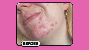 Pineapple Enzyme Peel Mask